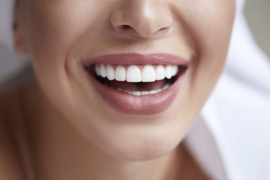 Veneers Cost