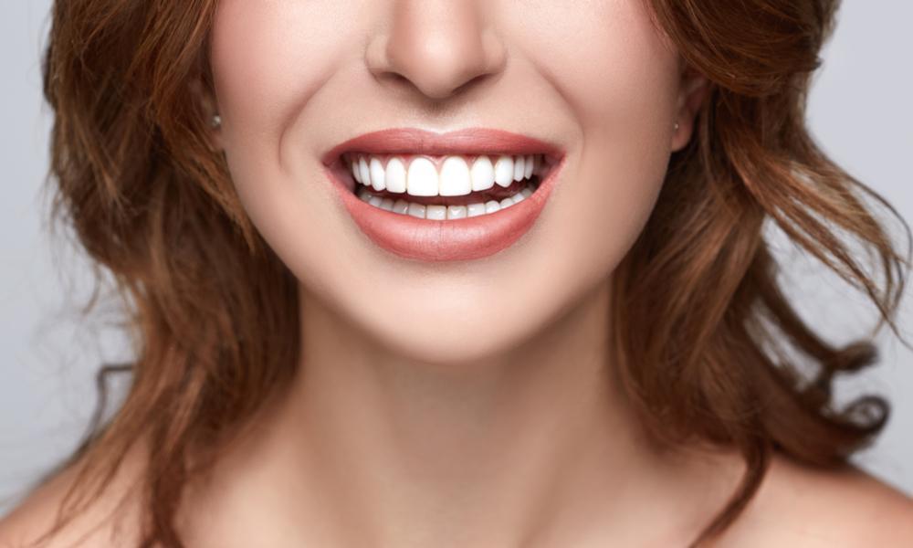 What Are Veneers
